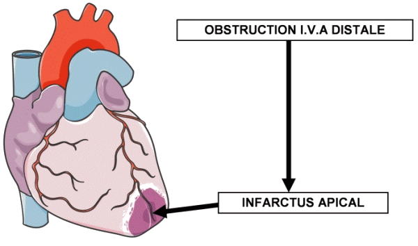 Infarctus