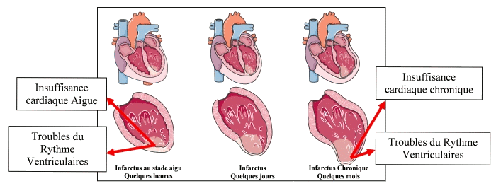 Les conséquences de l'infarctus